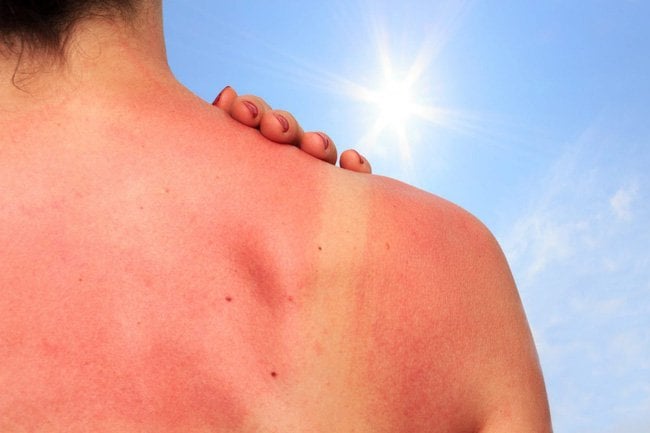 5 mẹo cấp cứu da cháy nắng đơn giản tránh làm da bị tổn thương, xuống cấp
